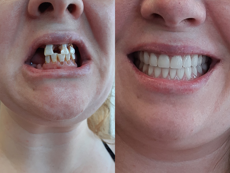 immediate dentures before and after